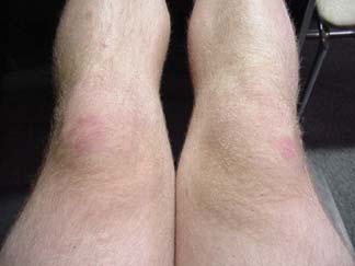U-Haul injury #4. Both knees bruised.