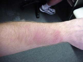 U-Haul injury #3. My left arm severly bruised.