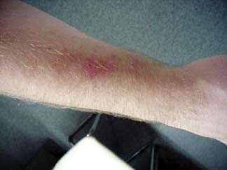 U-Haul injury #2. My right arm severely bruised.